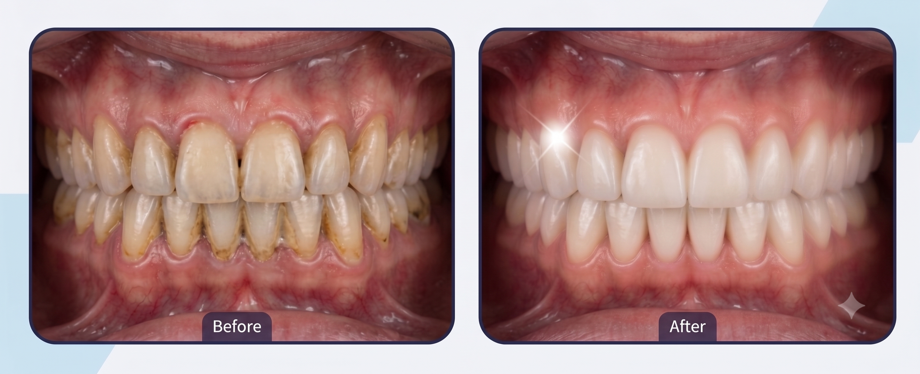 Smile Transformation 1 - White Orchid Dental Clinic