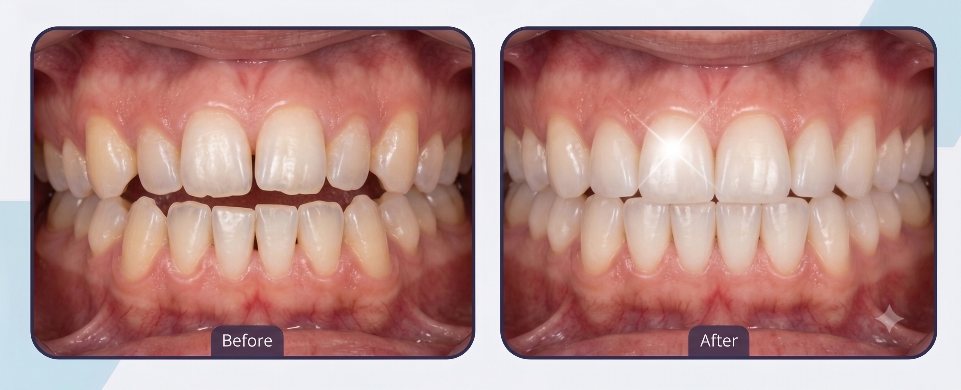 Smile Transformation 2 - White Orchid Dental Clinic