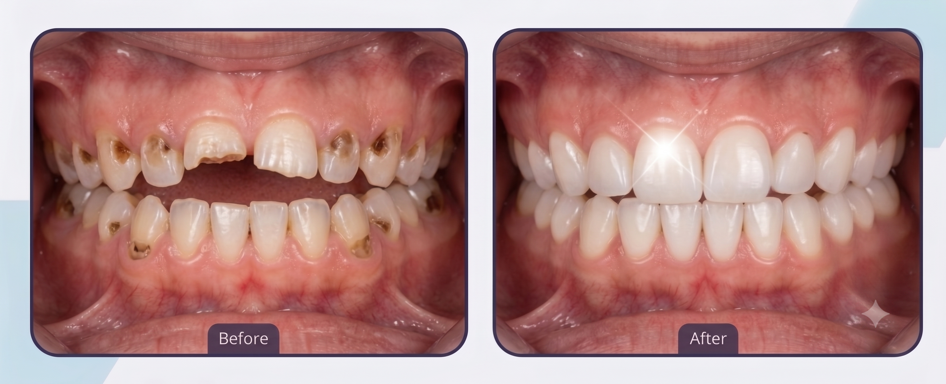 Smile Transformation 4 - White Orchid Dental Clinic