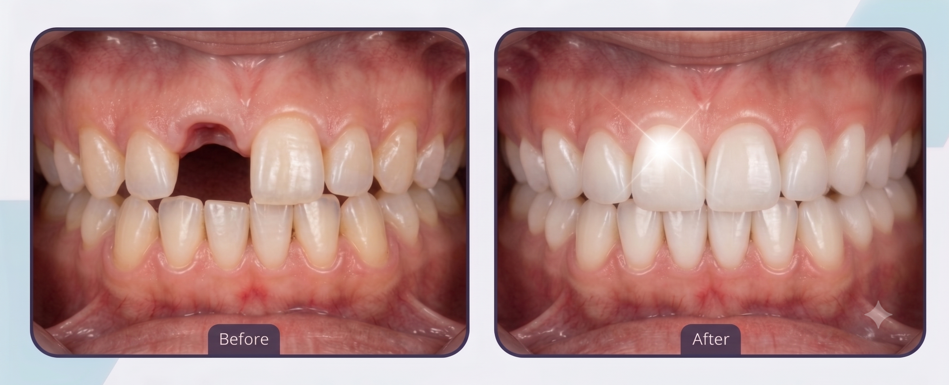 Smile Transformation 5 - White Orchid Dental Clinic