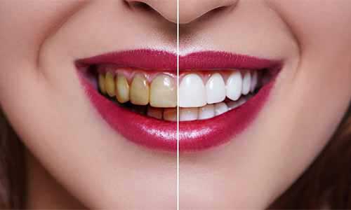Teeth Whitening / Bleaching